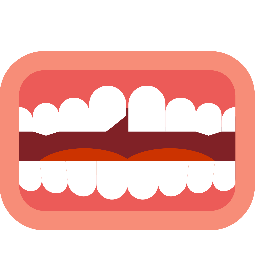 Broken or Chipped Tooth Repair