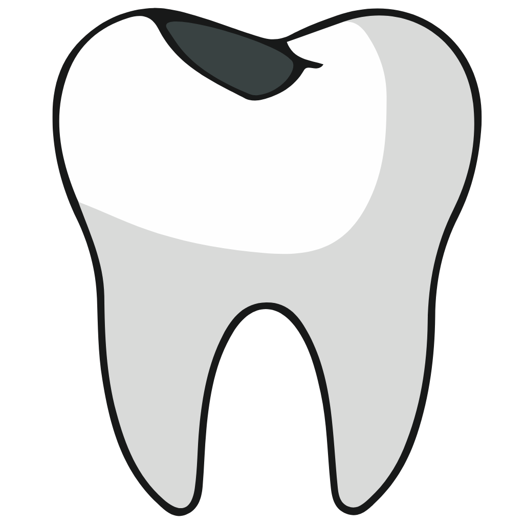 Cavity Fillings