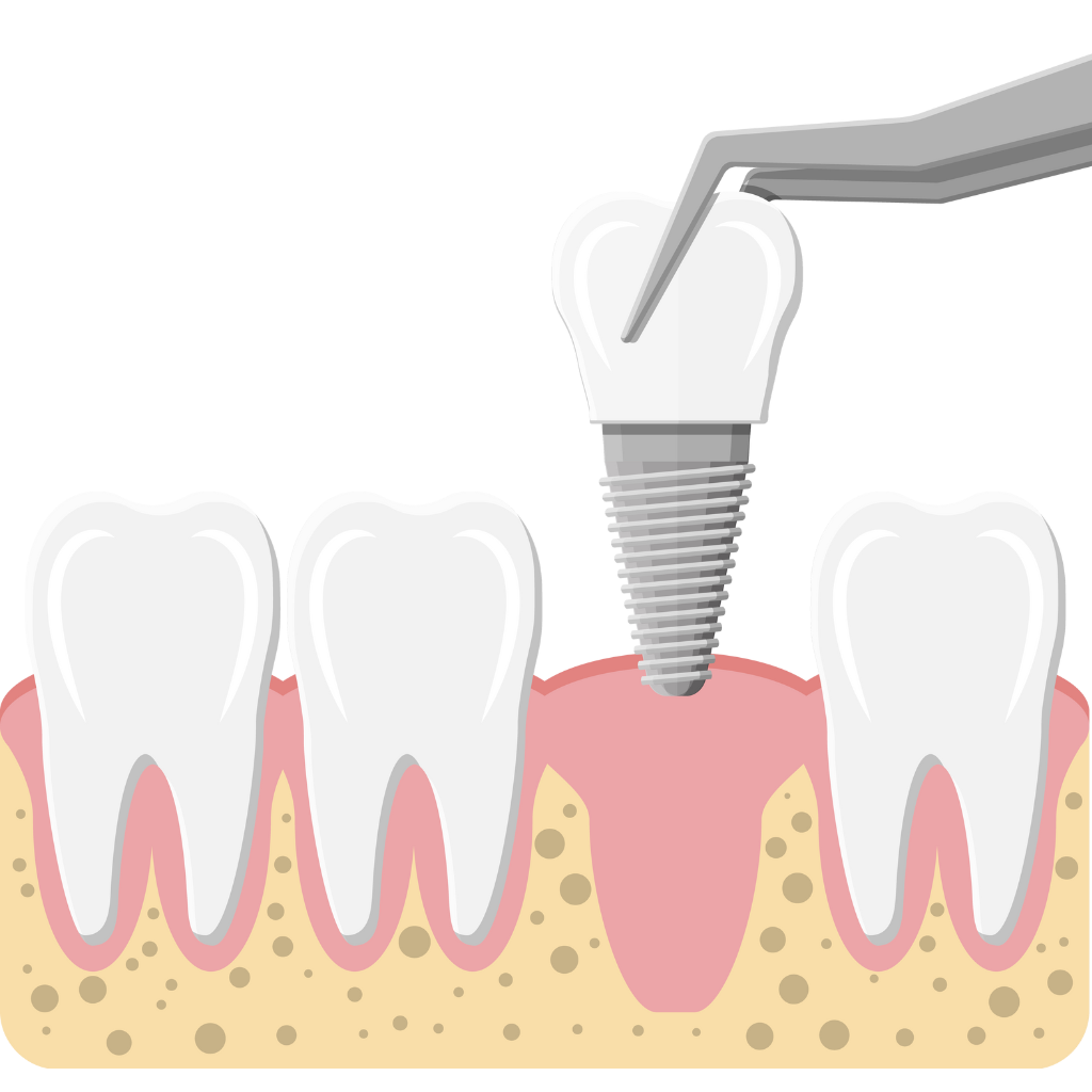 Dental Implants
