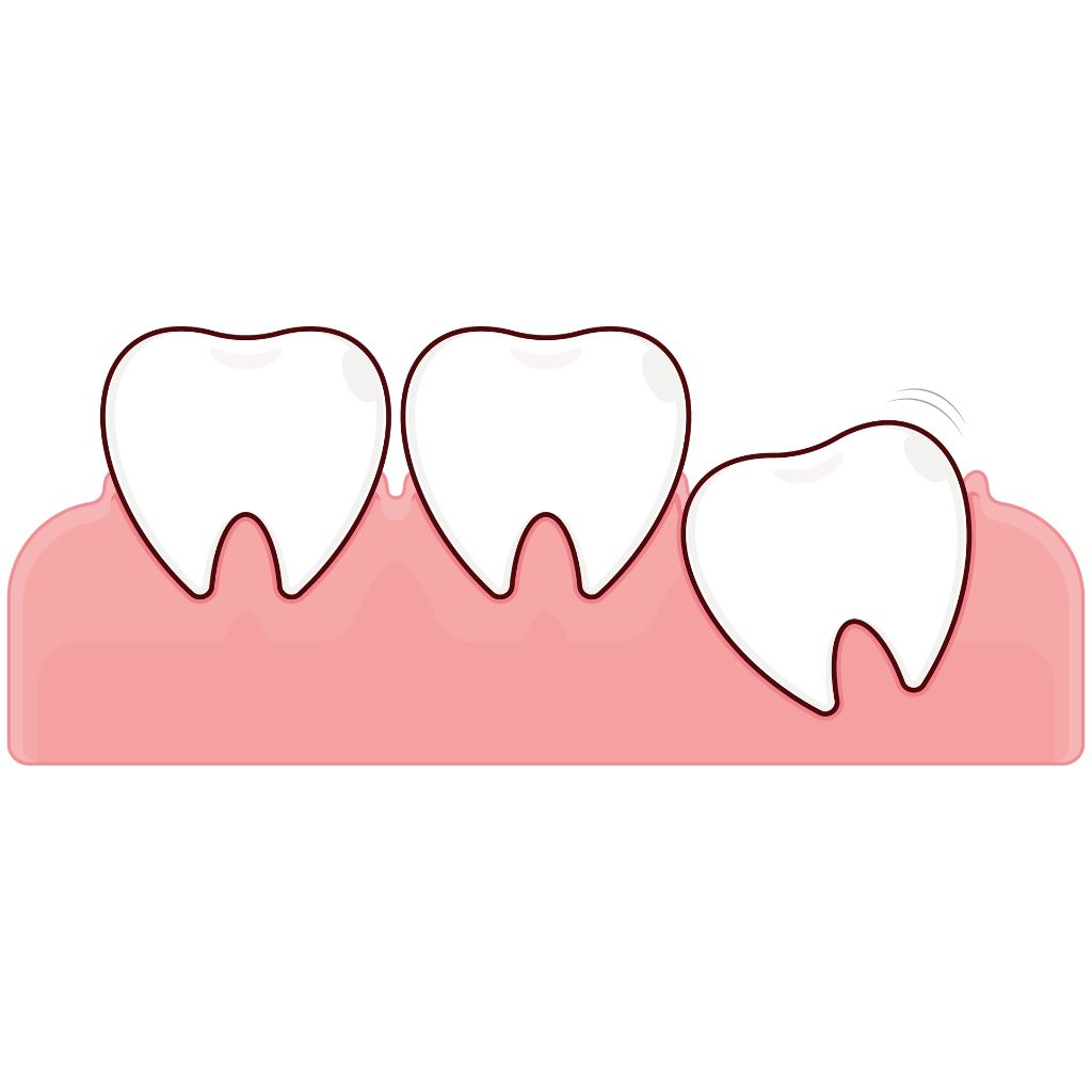 Wisdom Teeth Removal